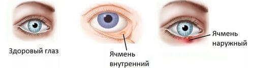 Как лечить быстро дома ячмень на глазу