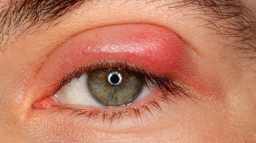 Как лечить быстро дома ячмень на глазу