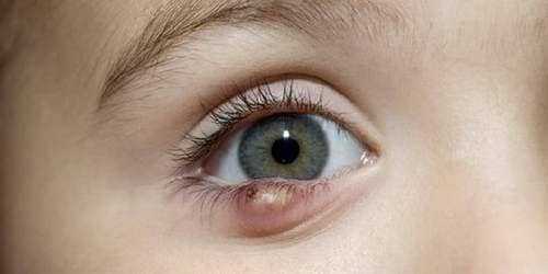 Как лечить быстро дома ячмень на глазу