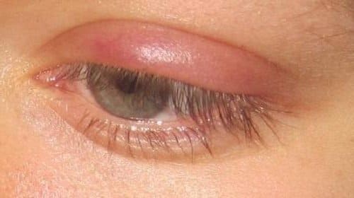 ячмень на глазу