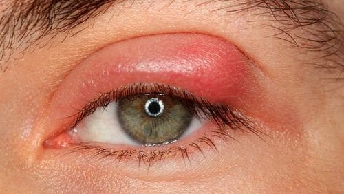 ячмень на глазу