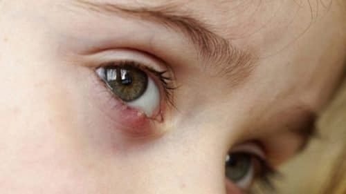 ячмень на глазу