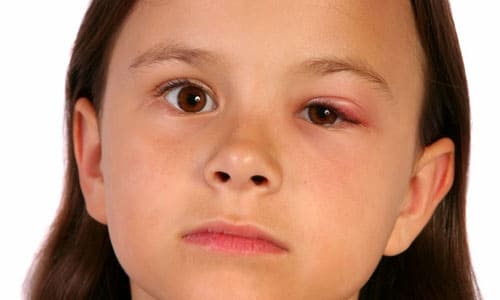 ячмень у ребенка